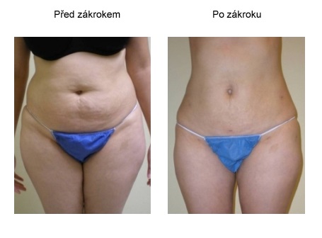 SlimLipo před a po břicho a stehna